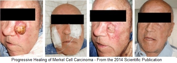 Progressive Healing of Merkel Cell Carcinoma